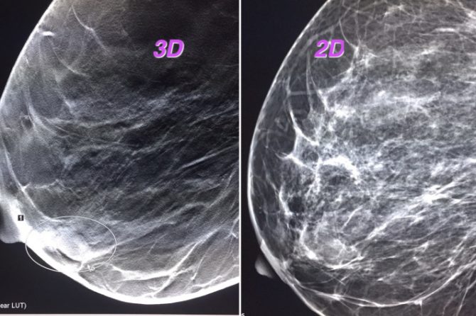 Γιατί η 3D μαστογραφία κάνει καλύτερη διάγνωση