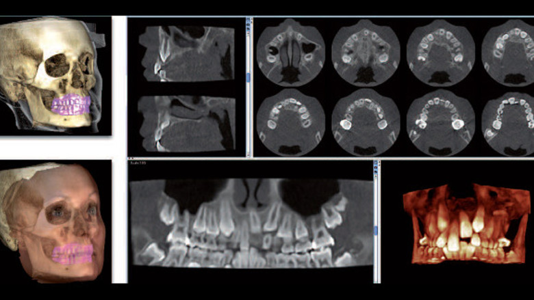 Αξονική Δοντιών στη Λάρισα με χαμηλή δόση ακτινοβολίας (έως -80%) | 3D ακτινογραφία δοντιών στη Λάρισα | Drakotos-Antonios_CBCT_Promax_3D_imgaging, ΔΡΑΚΩΤΟΣ Γ. ΑΝΤΩΝΙΟΣ - Ακτινοδιαγνώστης – Στρατιωτικός Ιατρός ε.α Ακτινολόγος Λάρισα. ακτινολόγος λαρισα. Ακτινολογικό ιατρείο λάρισα. Aktinologo larisa. Ακτινογραφία Λάρισα. Drakotos-Antonios, aktinografia larisa, aktinologos larisa. Ακτινολόγος λάρισα, οικονομική ακτινογραφία, Ακτινολογικό Εργαστήριο στη Λάρισα, ακτινολογοι στη Λάρισα. Δρακωτός Γ. Αντώνιος. ΜΑΡΙΝΟΥ ΑΝΤΥΠΑ 2 κ ΚΟΥΜΑ, Κεντρική Πλατεία, Λάρισα. Τηλ.(2410) 258 000. Ακτινογραφία με απόλυτη ακρίβεια και μειωμένη έκθεση σε κίνδυνο. Planmeca ProMax 3D. Αξονική τομογραφία οδόντων κωνικής δέσμης CBCT. Έγχρωμα doppler υπερηχογραφήματα οσχέου. Έλεγχος fistula. Αξονική τομογραφία οδόντων κωνικής δέσμης CBCT. Ακτινογραφία ολόκληρης της άνω και κάτω γνάθου με μία μόνο λήψη. Ακτινογραφία Ultra Low Dose με ιδιαίτερα χαμηλή δόση ακτινοβολίας μειωμένη κατά 80% μικρότερη της τυπικής πανοραμικής. Ενδοοδοντολογία με ιδιαίτερα υψηλή ανάλυσηγια. Προσομοίωση τοποθέτησης εμφυτεύματος. Aktinografia larisa, Drakotos-Antonios, Δρακωτός Γ. Αντώνιος. Aktinologos larisa, aktinologos larissa, ακτινολόγος λάρισα, ακτινολόγος λάρισσα, οικονομική ακτινογραφία. Ακτινολογικό Εργαστήριο στη Λάρισα, ακτινολόγοι στη Λάρισα. Γιατροί ακτινολόγοι Λάρισα, ιατροί ακτινολόγοι Λάρισα. Υπερηχογραφήματα Λάρισα, Υπερηχογράφημα Λάρισα, giatros larisa, γιατρός Λάρισα.