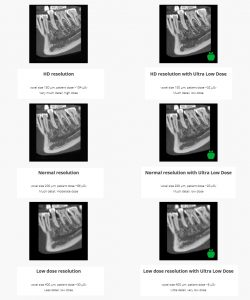 Τρισδιάστατη Αξονική Τομογραφία οδόντων (CBCT) με 75% μικρότερη δόση ακτινοβολίας στο μηχάνημα Πανοραμικής Ακτινογραφίας στο my doctor