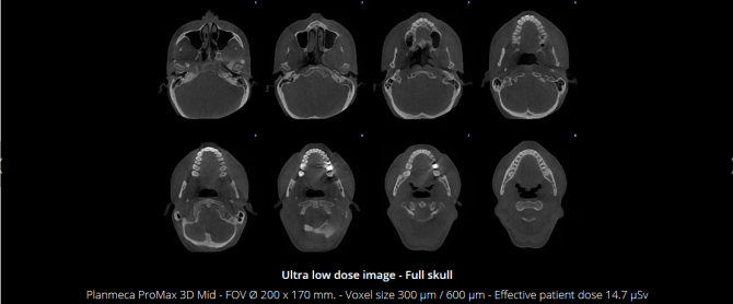Planmeca Ultra Low Dose 3D imaging(2)