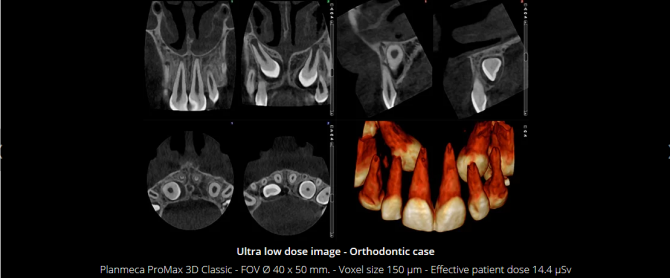 Planmeca Ultra Low Dose 3D imaging(3)