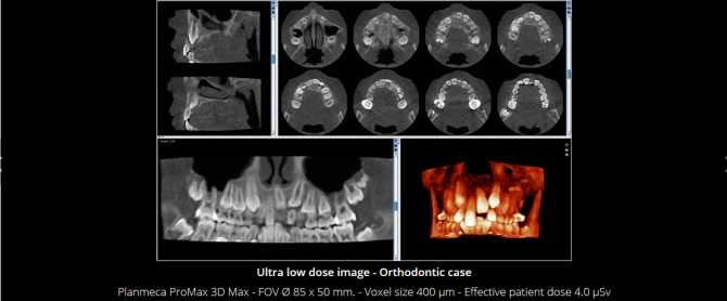 Planmeca Ultra Low Dose 3D imaging(5)