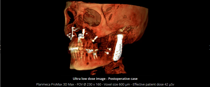Planmeca Ultra Low Dose 3D imaging(8)