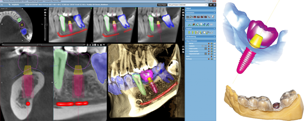 Αξονική Δοντιών στη Λάρισα με χαμηλή δόση ακτινοβολίας (έως -80%) | 3D ακτινογραφία δοντιών στη Λάρισα | Εξελιγμένο πρόγραμμα Planmeca Romexis 4.5 Παροχή του νέου εξελιγμένου προγράμματος Planmeca Romexis 4.5 το οποίο είναι κοινό σε όλα τα προγράμματα των υποειδικοτήτων της οδοντιατρικής και όλα τα μηχανήματα της εταιρίας. | Drakotos-Antonios_CBCT_Promax_3D_imgaging, ΔΡΑΚΩΤΟΣ Γ. ΑΝΤΩΝΙΟΣ - Ακτινοδιαγνώστης – Στρατιωτικός Ιατρός ε.α Ακτινολόγος Λάρισα. ακτινολόγος λαρισα. Ακτινολογικό ιατρείο λάρισα. Aktinologo larisa. Ακτινογραφία Λάρισα. Drakotos-Antonios, aktinografia larisa, aktinologos larisa. Ακτινολόγος λάρισα, οικονομική ακτινογραφία, Ακτινολογικό Εργαστήριο στη Λάρισα, ακτινολογοι στη Λάρισα. Δρακωτός Γ. Αντώνιος. ΜΑΡΙΝΟΥ ΑΝΤΥΠΑ 2 κ ΚΟΥΜΑ, Κεντρική Πλατεία, Λάρισα. Τηλ.(2410) 258 000. Ακτινογραφία με απόλυτη ακρίβεια και μειωμένη έκθεση σε κίνδυνο. Planmeca ProMax 3D. Αξονική τομογραφία οδόντων κωνικής δέσμης CBCT. Έγχρωμα doppler υπερηχογραφήματα οσχέου. Έλεγχος fistula. Αξονική τομογραφία οδόντων κωνικής δέσμης CBCT. Ακτινογραφία ολόκληρης της άνω και κάτω γνάθου με μία μόνο λήψη. Ακτινογραφία Ultra Low Dose με ιδιαίτερα χαμηλή δόση ακτινοβολίας μειωμένη κατά 80% μικρότερη της τυπικής πανοραμικής. Ενδοοδοντολογία με ιδιαίτερα υψηλή ανάλυσηγια. Προσομοίωση τοποθέτησης εμφυτεύματος. Aktinografia larisa, Drakotos-Antonios, Δρακωτός Γ. Αντώνιος. Aktinologos larisa, aktinologos larissa, ακτινολόγος λάρισα, ακτινολόγος λάρισσα, οικονομική ακτινογραφία. Ακτινολογικό Εργαστήριο στη Λάρισα, ακτινολόγοι στη Λάρισα. Γιατροί ακτινολόγοι Λάρισα, ιατροί ακτινολόγοι Λάρισα. Υπερηχογραφήματα Λάρισα, Υπερηχογράφημα Λάρισα, giatros larisa, γιατρός Λάρισα.