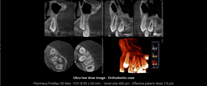 Planmeca Ultra Low Dose 3D imaging(4)